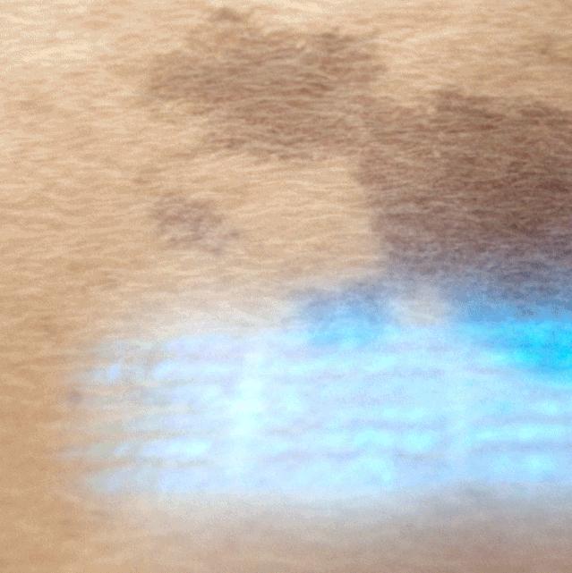 爱长斑的女人怎么办,女生长斑