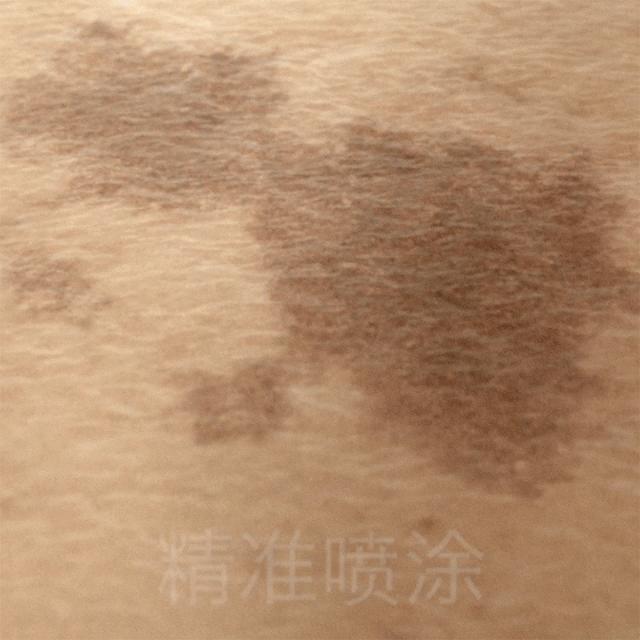 爱长斑的女人怎么办,女生长斑