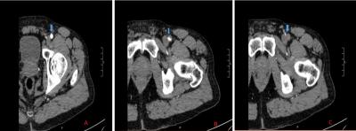 胳膊疼了一晚上是心梗吗,腿疼就是心梗吗