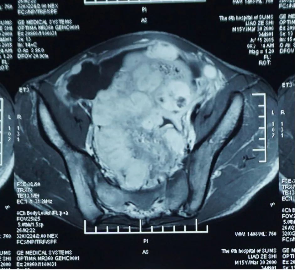 肌纤维母细胞瘤成功案例,炎性肌纤维母细胞瘤最佳治疗方案