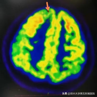 最先进有效的癫痫手术,癫痫手术是否能一次治愈