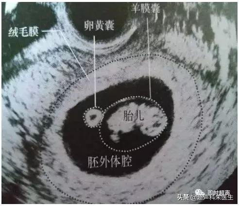 妇科超声的标准超声图,妇科超声图解