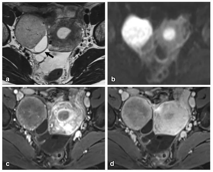 卵巢实性为主肿瘤，这13种你都想到了吗？