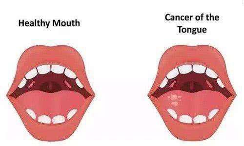 舌癌术后康复功能训练（上）——舌癌术后康复之言语篇