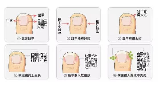 指甲往肉里长怎么办一碰就疼,怎么治甲沟炎的指甲不再长肉里