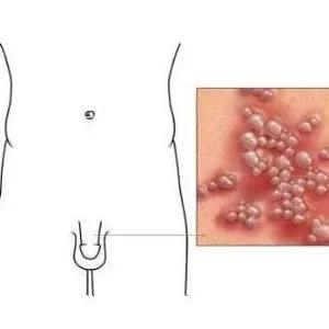 有哪些疾病性传播的,不是性传播的疱疹也不能根治吗