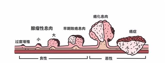 食管壁上美丽的“莲花”在无痛胃肠镜下现出了魔影
