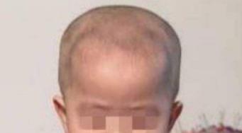 孩子的头偏小怎么办,孩子扁头偏头