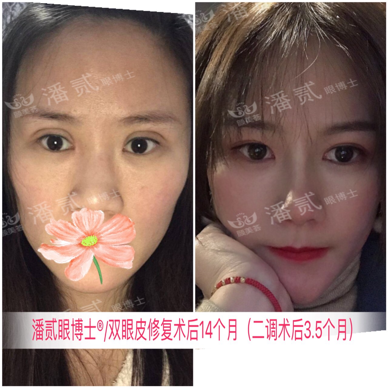 双眼皮手术失败修复还会失败吗,双眼皮第一次修复后1-7天恢复图