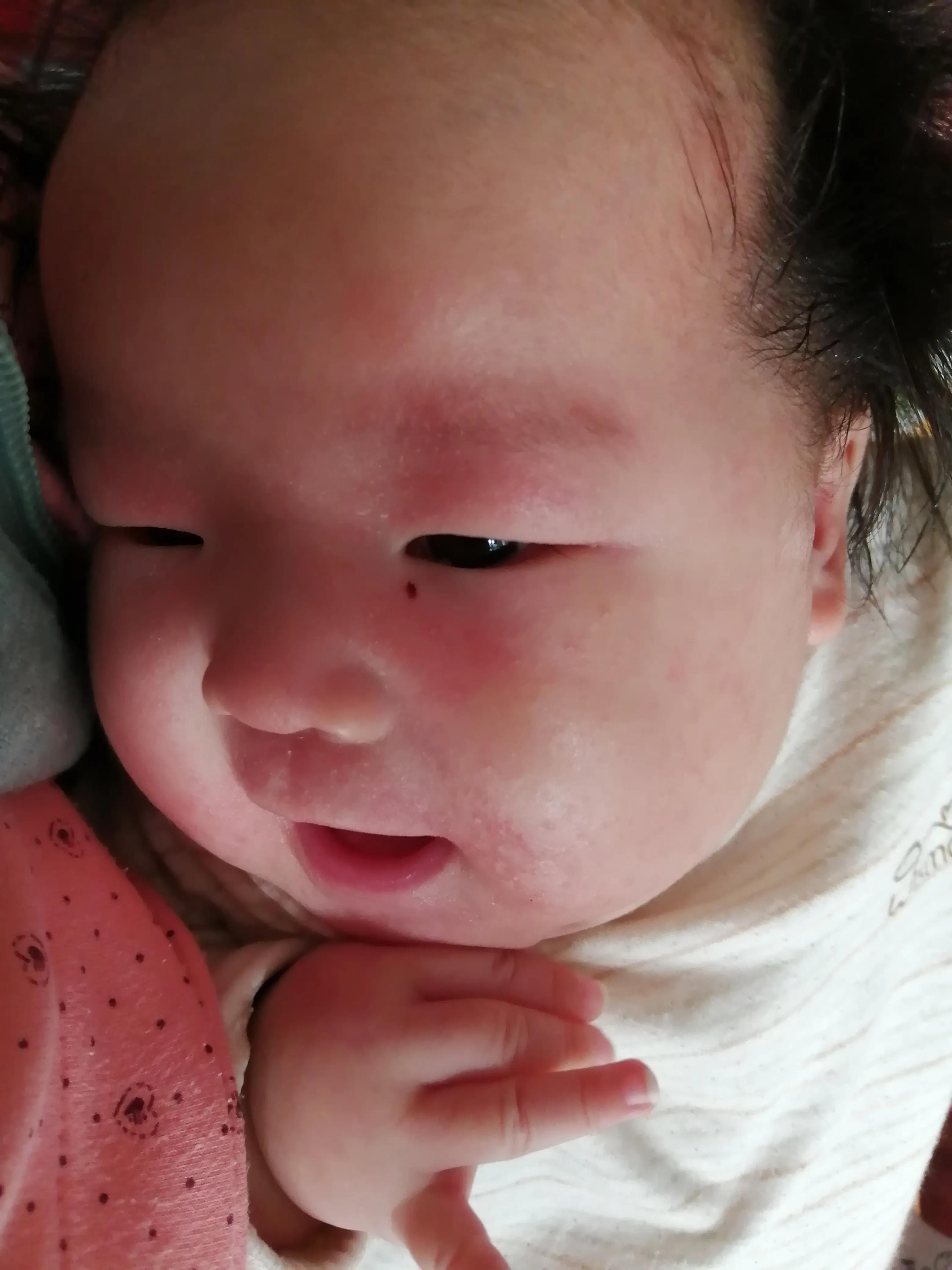 婴儿湿疹治疗心路,宝宝湿疹攻略