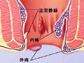 痔疮手术后预防水肿怎么按摩,痔疮是需要怎样治疗