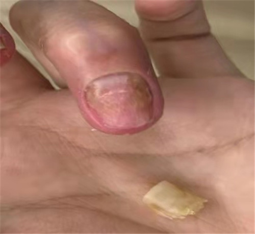 银屑病特效新药,银屑病关节炎专用药