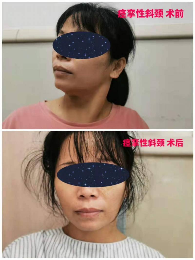 切断关键神经治疗“歪脖子”，广州专家找到全新根治性方案