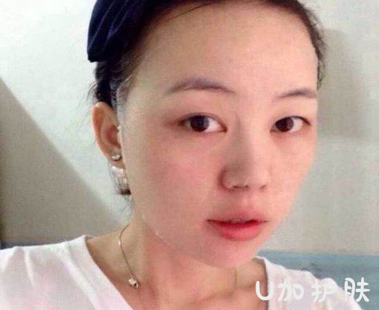 脸上痘痘换季越来越多5招防痘痘,换季长痘痘的正确护肤方法