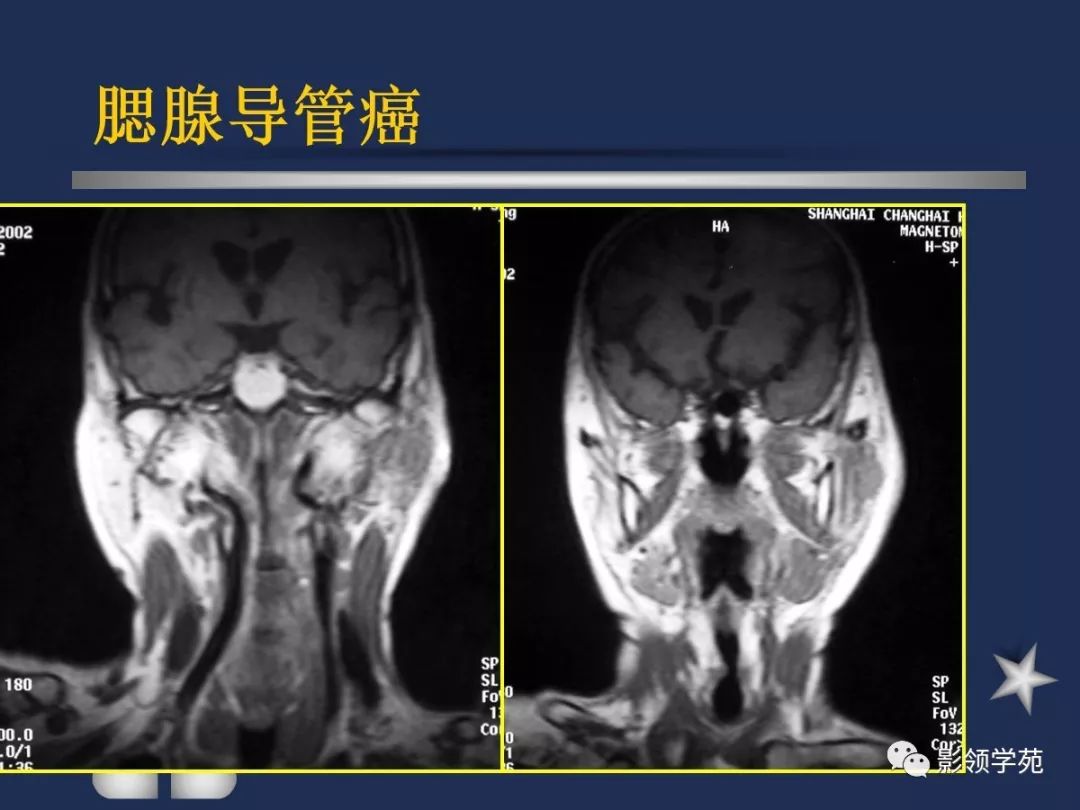 腮腺疾病影像学诊断,腮腺肿块影像诊断