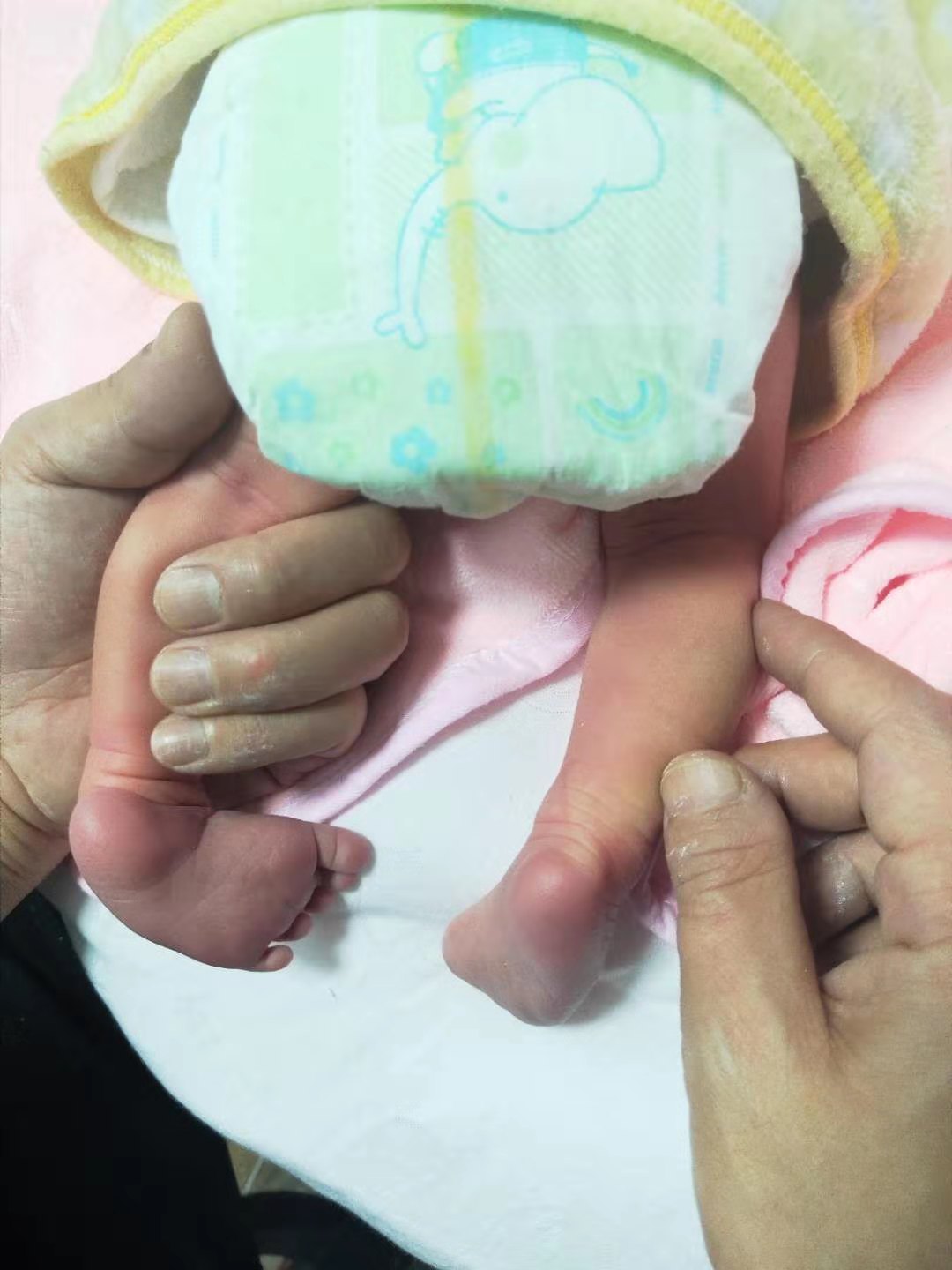 严重马蹄足内翻胎儿能要吗,孕期发现严重的足内翻需要引产吗