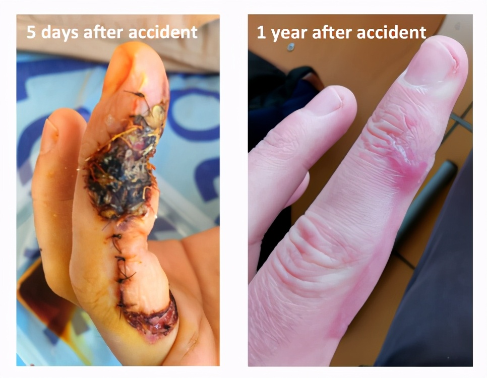 被实验室注射器针头扎到手,被实验室针头扎了一下怎么办