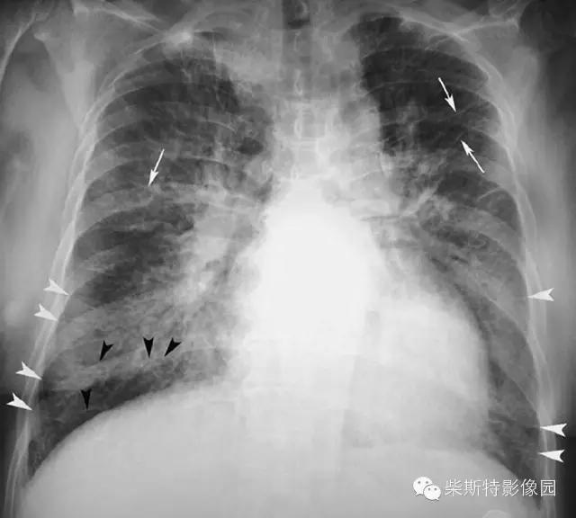 影像经典之KerleyA线、KerleyB线、KerleyC线