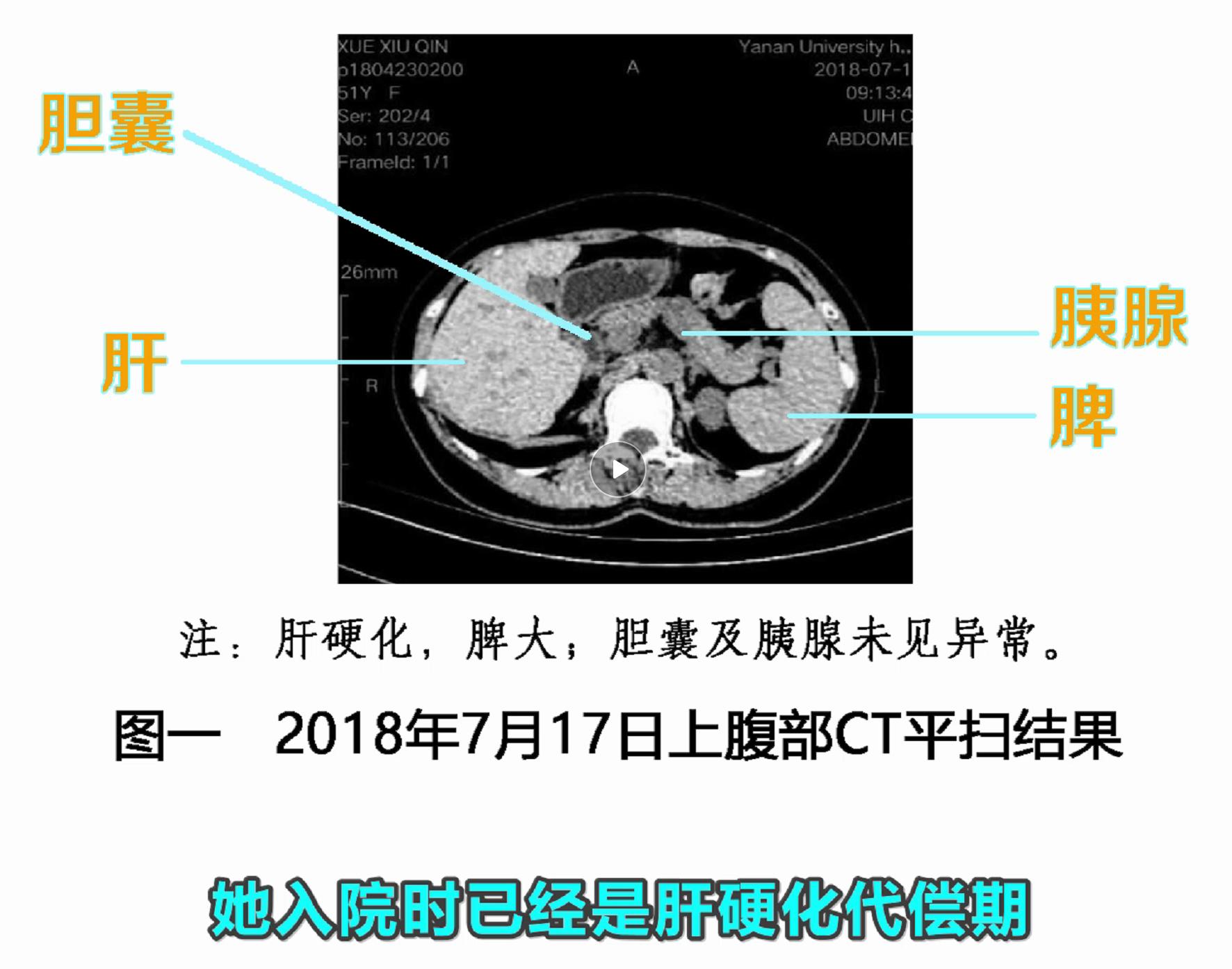 病毒性早期肝硬化干扰素能逆转吗,干扰素可以逆转肝硬化吗