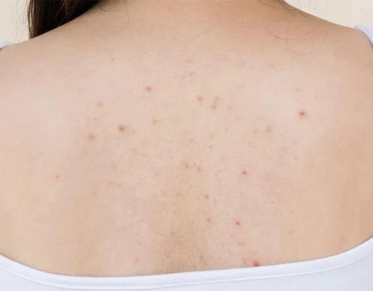 夏天露肉的季节,露肉的正确美白方法