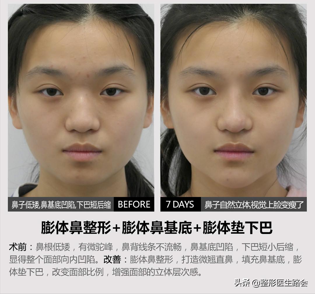 韩式隆鼻是不是就是单纯隆鼻,韩式隆鼻一般要多少钱一次案例