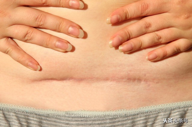 子宫瘢痕厚度0.35建议提前剖腹产,子宫疤痕多少毫米需要剖腹产