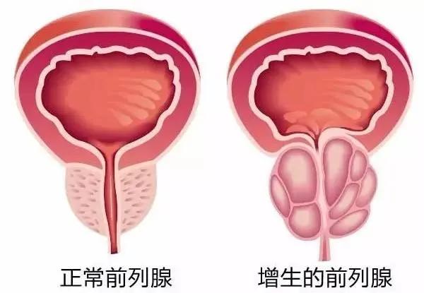 阜新市中心医院：是什么“偷走”我自主排尿的功能