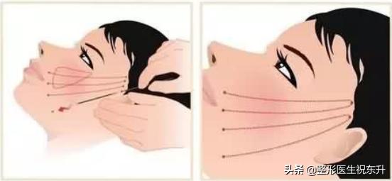 30岁做线雕提升还是筋膜悬吊,最新抗衰线雕