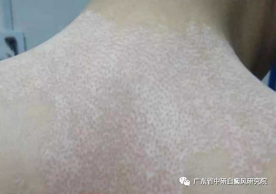 手指白癜风白斑变红是好转迹象吗,脚上白癜风308后发红是好转迹象吗