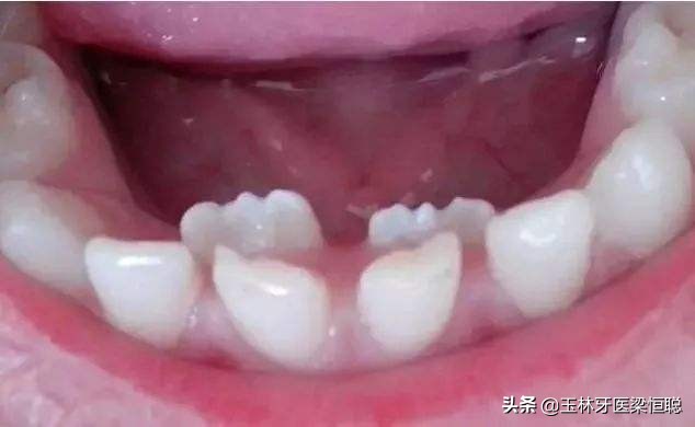 儿童门牙锯齿状多长时间会磨平,孩子的门牙长得像锯齿一样怎么办