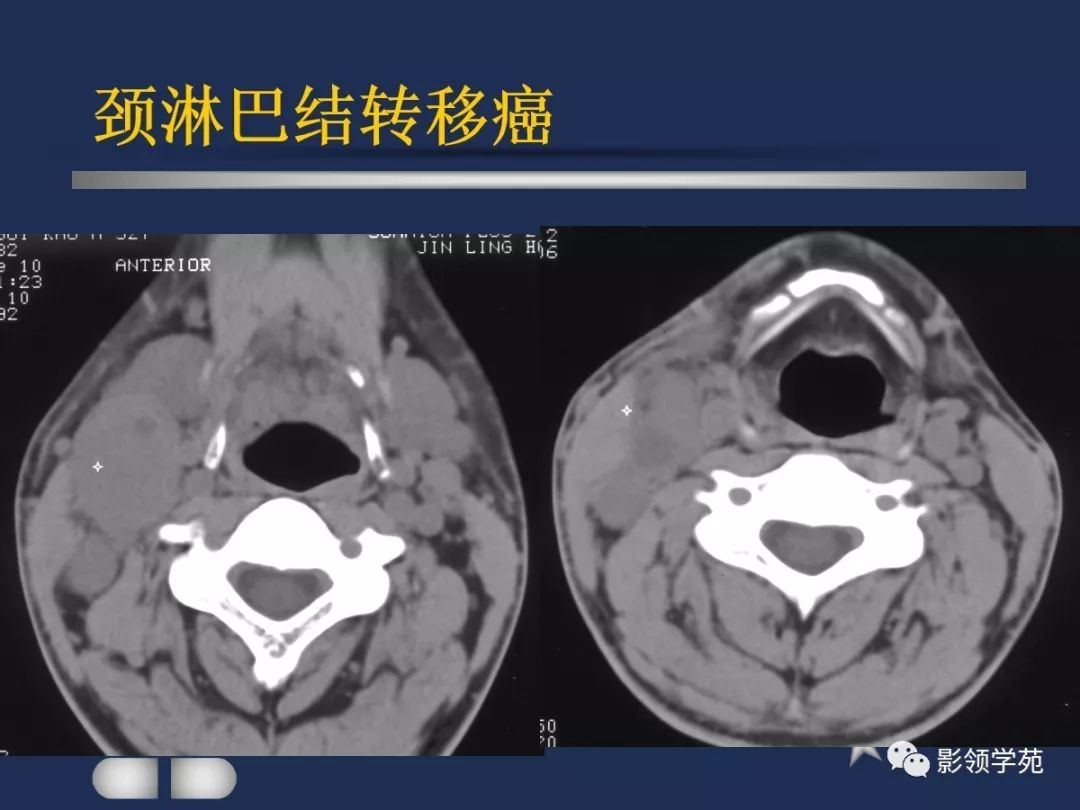 腮腺疾病影像学诊断,腮腺肿块影像诊断