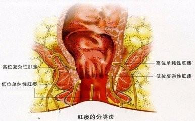 医生说的小肛瘘,医生判断肛瘘会不会有误诊