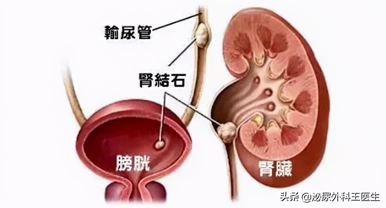 排石颗粒真的可以使结石变小吗,结石通和排石颗粒哪个效果更好