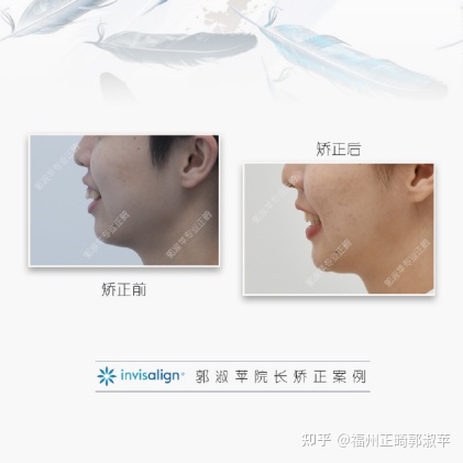 牙齿龅牙矫正过程全记录33岁,大龅牙牙齿矫正成功案例和费用