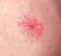 身上突然长咖啡色肉痣是咋回事,身上出现红色痣一定与肝脏有关吗