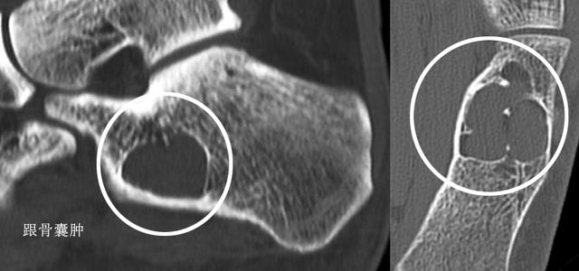 足跟疼痛教你一招百试百灵,早起落地脚疼