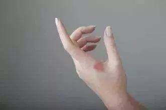 一块钱的红霉素眼膏，功能超级强大，网友亲测有效！