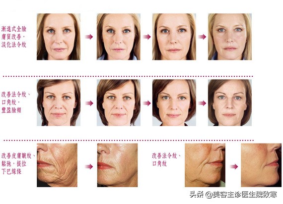 魏致寒：“童颜针到底是什么？最全的科普文章！”