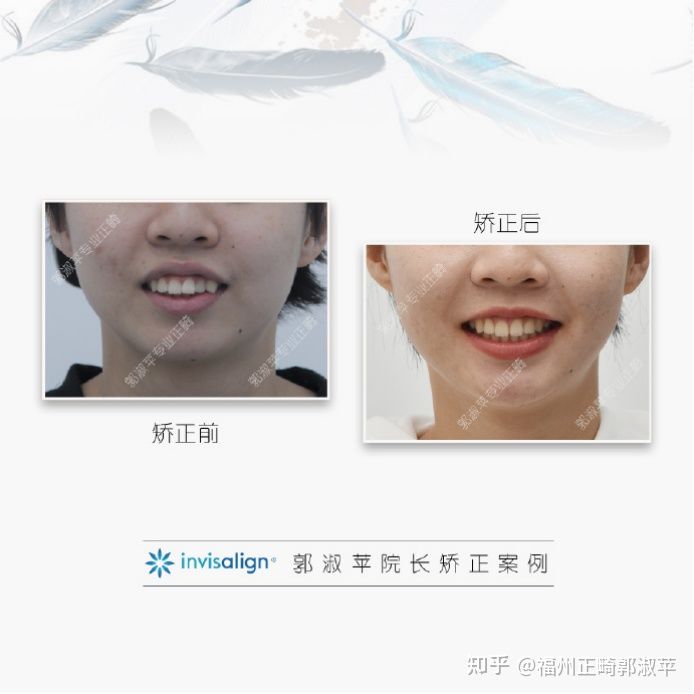 牙齿龅牙矫正过程全记录33岁,大龅牙牙齿矫正成功案例和费用