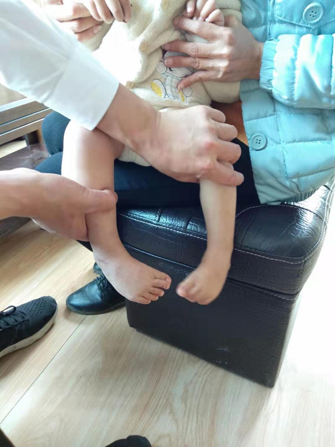 严重马蹄足内翻胎儿能要吗,孕期发现严重的足内翻需要引产吗