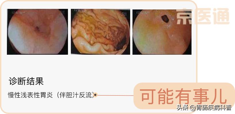 肠胃镜报告要等多久,教你3分钟看懂胃镜活检病理报告