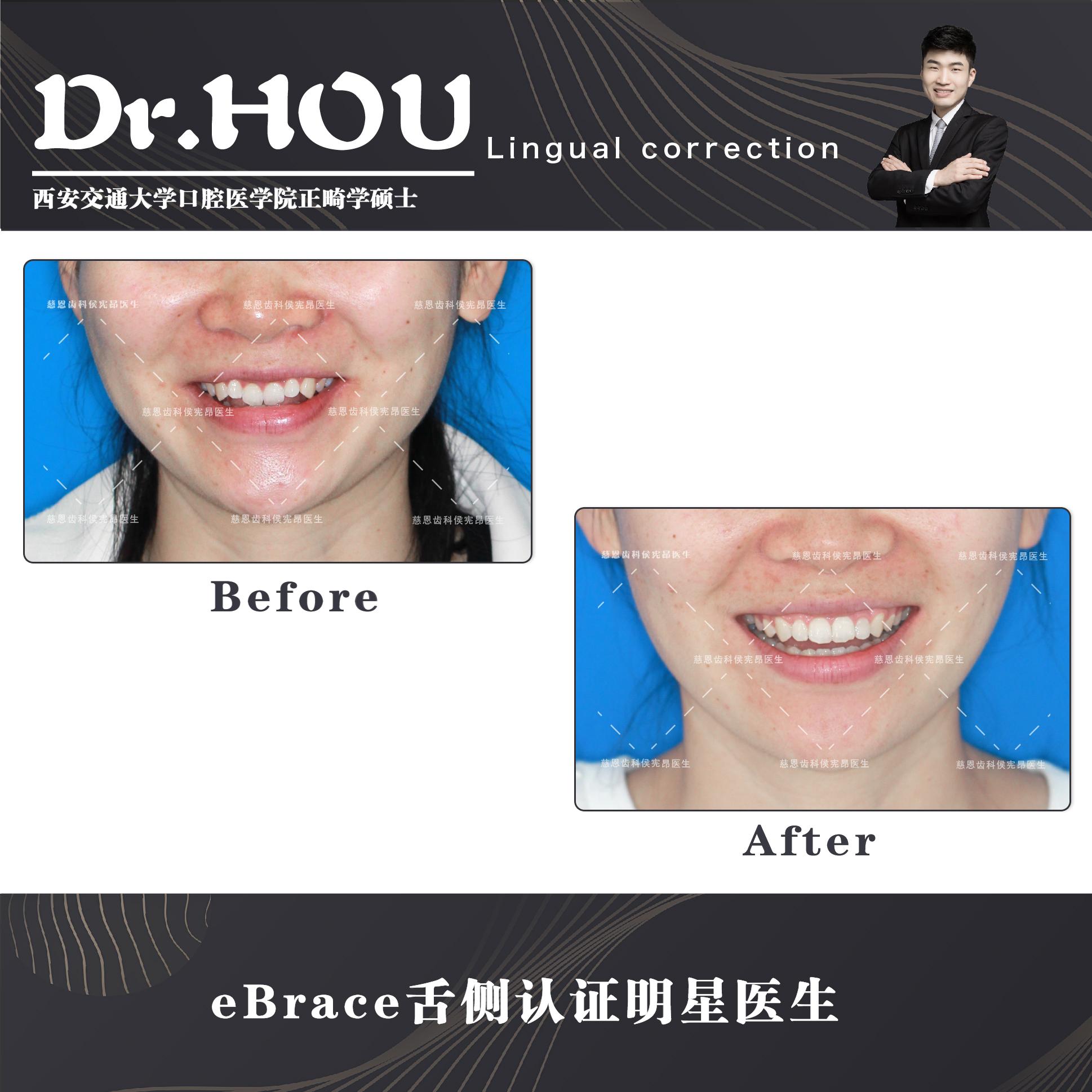 地包天的牙齿图片,牙齿地包天怎么补救