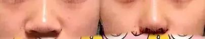 协和整形美容科专家,北京协和整形鼻综合