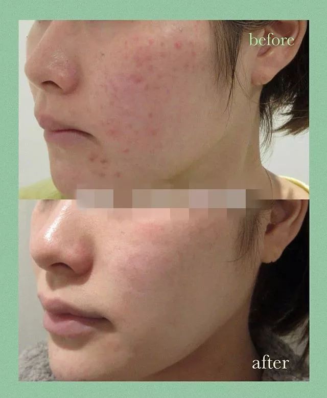 我用空瓶了几十瓶面霜的经验告诉你，谁才是真正的干皮亲妈