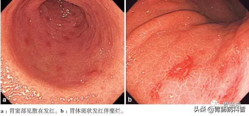 慢性非萎缩胃炎与浅表性胃炎区别,慢性非萎缩性胃炎浅表性胃炎区别