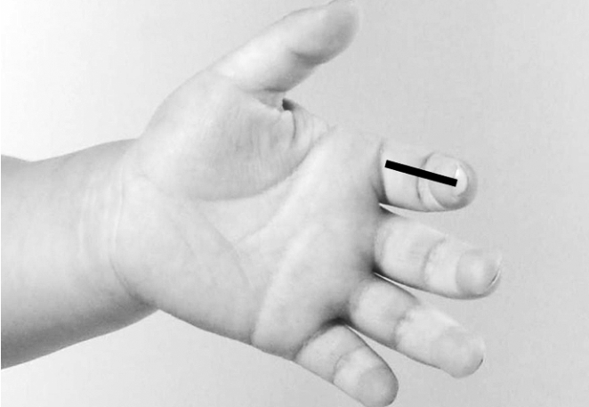 小儿感冒夹惊机制,小孩发烧惊风中医调理