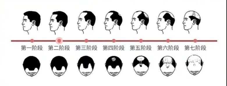还在为脱发秃顶烦恼吗,还在为掉发脱发而烦恼吗