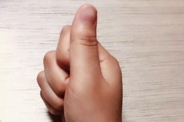 脑卒中如何治疗,脑卒中是什么如何康复治疗