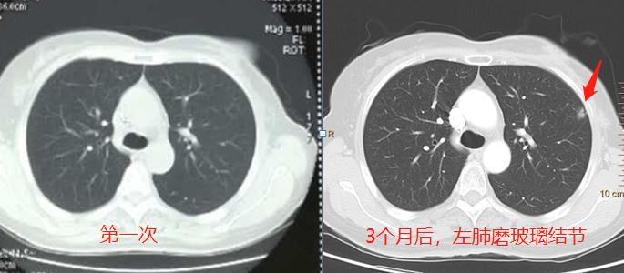 肺癌就像黑涩会，这3步重拳打出去，能抓住80%的肺癌团伙