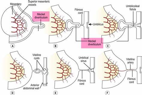 卵巢卵黄囊瘤是绝症吗,恶性卵黄囊瘤会变成良性的吗